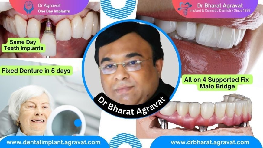 Best Dentist for Full Mouth Dental Implants Clinic in Ahmedabad: Dr. Bharat Agravat, the  top Implantologist.