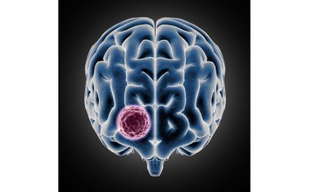 Sakra performs landmark surgery on 10×9 cm giant meningioma for 34-year-old Ghanaian patient