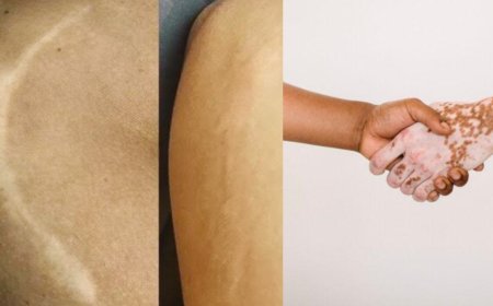 Scar and Vitiligo Treatment in Mumbai, Vitiligo and Scar Treatment Clinic in Mumbai – BrowMaster