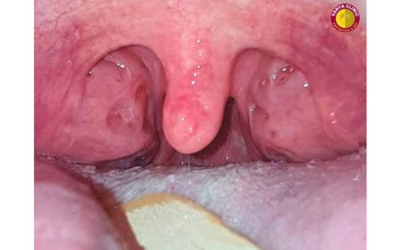 From Mama – Baba to Thank You Doctor : Dr. Purodha Prasad ENT Surgery Changes a Young Life in Delhi NCR